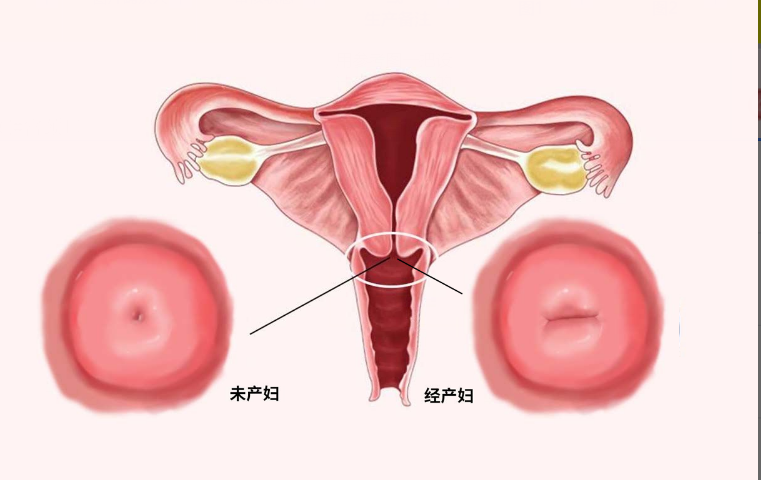 经产妇和初产妇宫颈口区别图片（经产妇和初产妇有什么区别）
