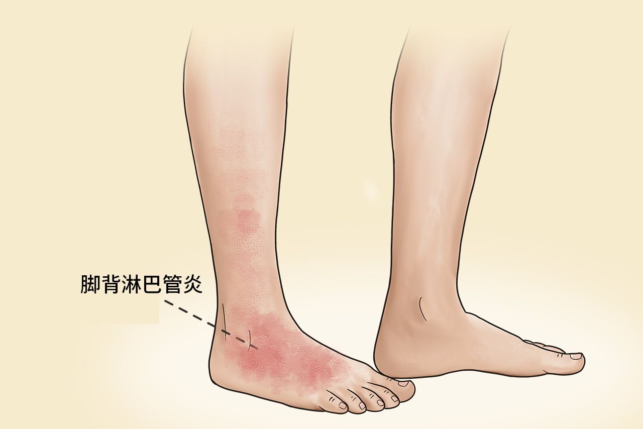 脚背淋巴管炎症状图片 脚背淋巴管炎图片