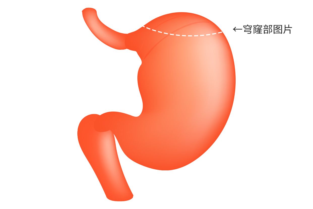 胃底穹窿部图片 胃底穹窿处是哪里图