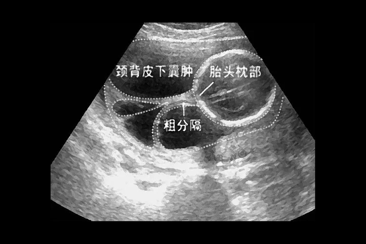 四个月胎儿颈部水囊瘤图片 3个月胎儿颈部水囊瘤