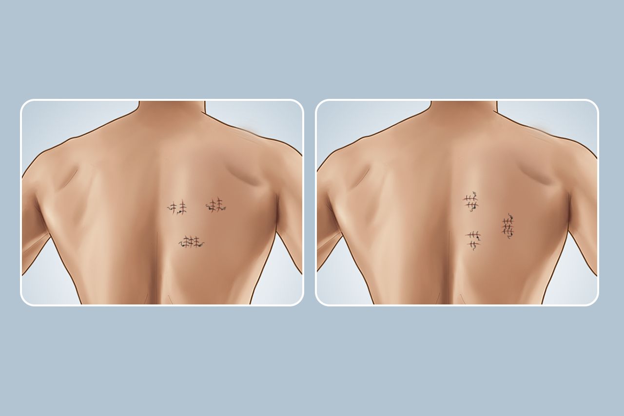 背部手术切口方向图片 背部切口设计