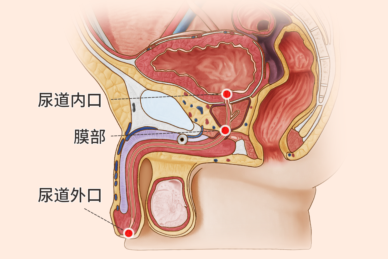 尿道狭窄图片（尿道狭窄部位）