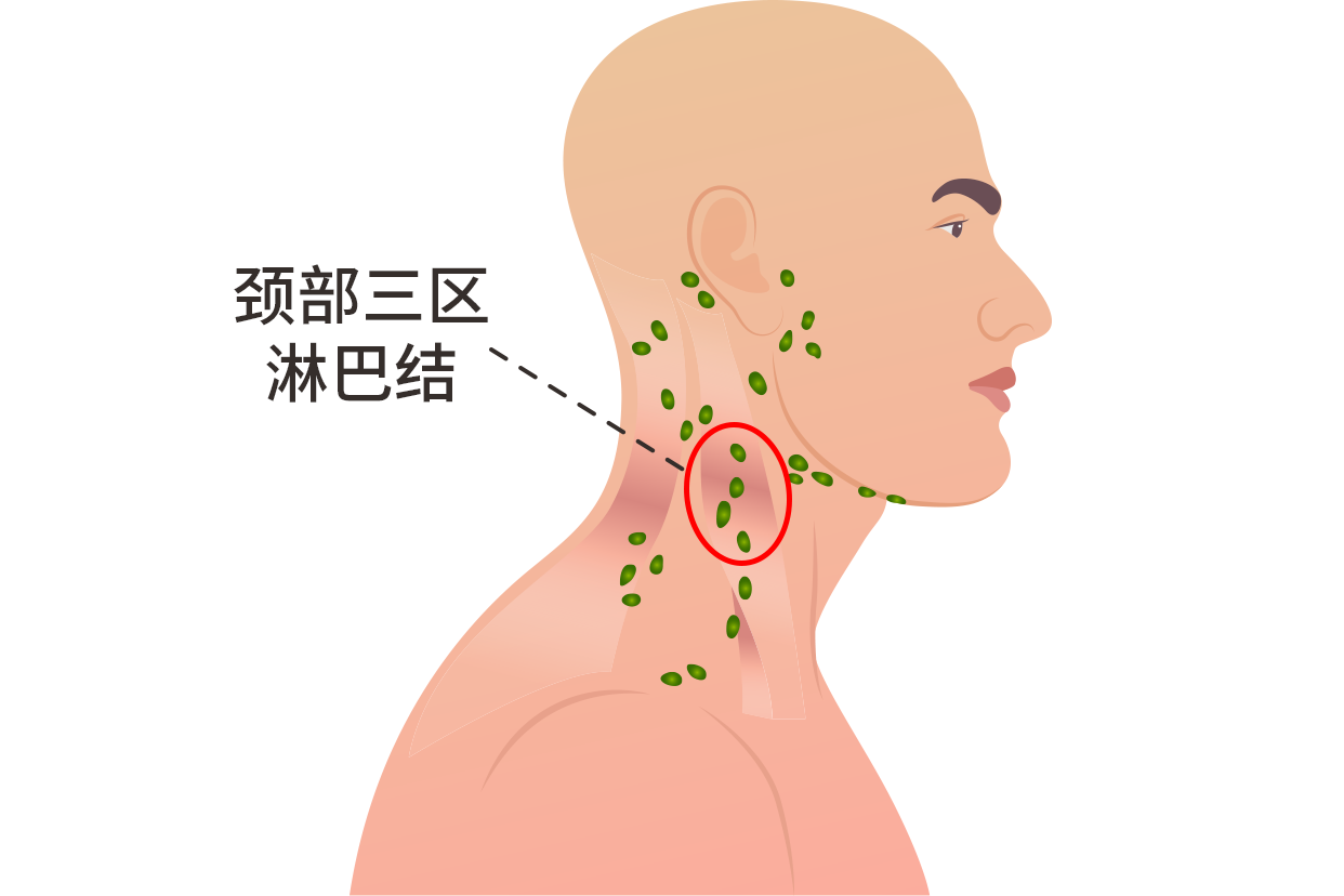 颈部三区淋巴结位置图（颈部二三区淋巴结在哪个位置）