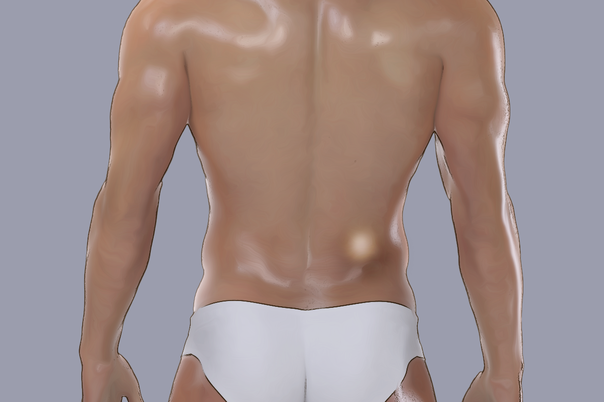 后腰部长脂肪瘤照片（腰后面长脂肪瘤）