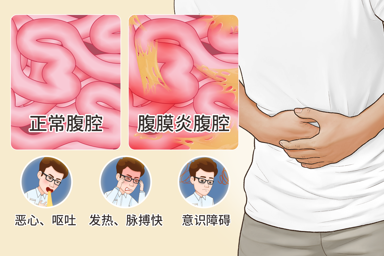 腹膜炎图片 腹膜炎位置图