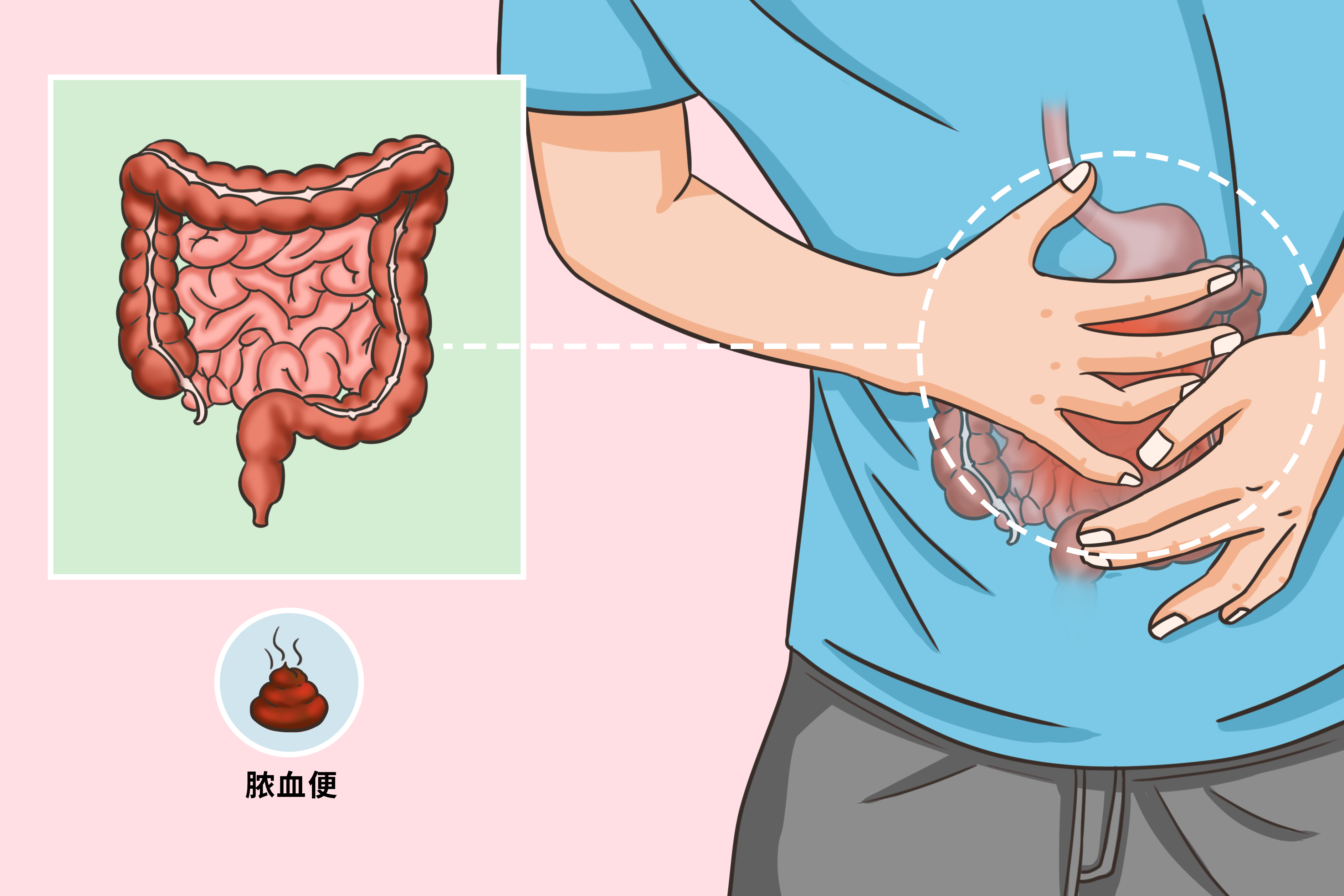 溃疡性结肠炎脓血便图片