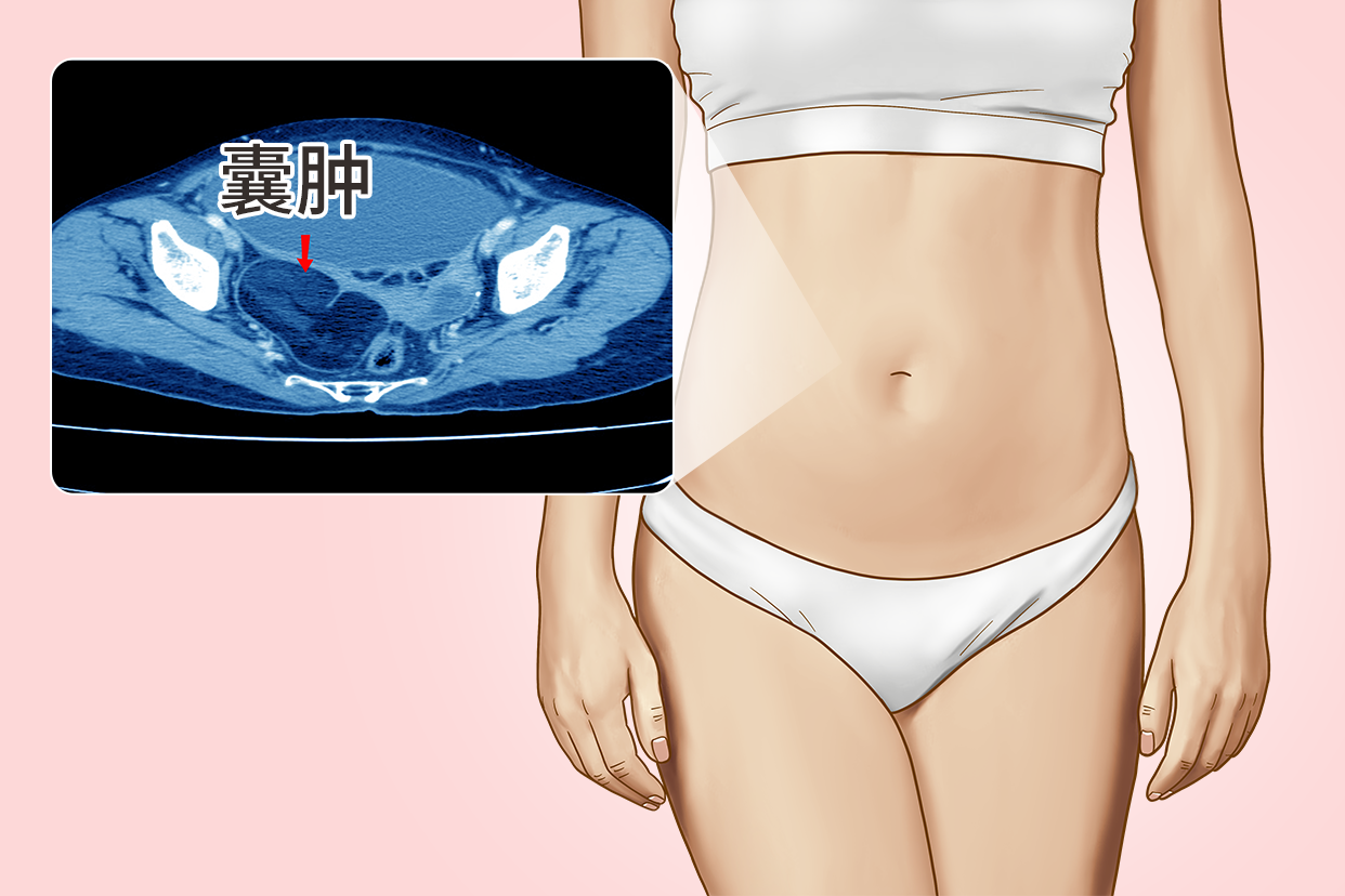 女性腹腔内巨大囊肿图片