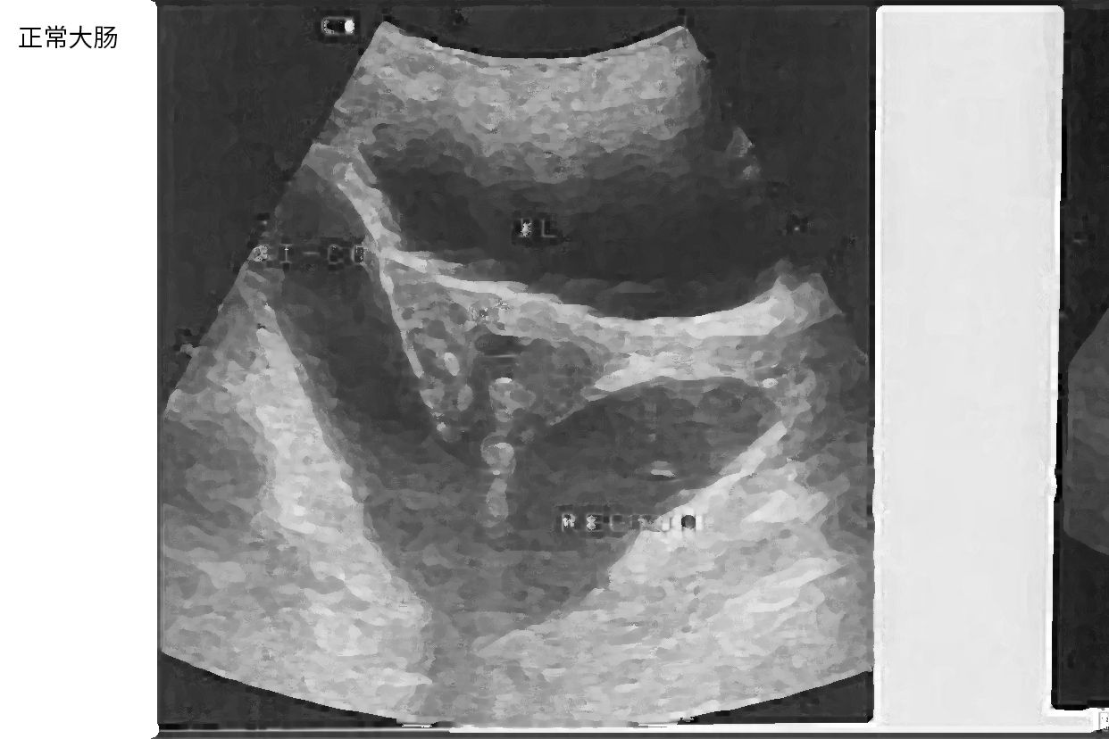 大肠和小肠的超声图像 肠管的超声影像是什么