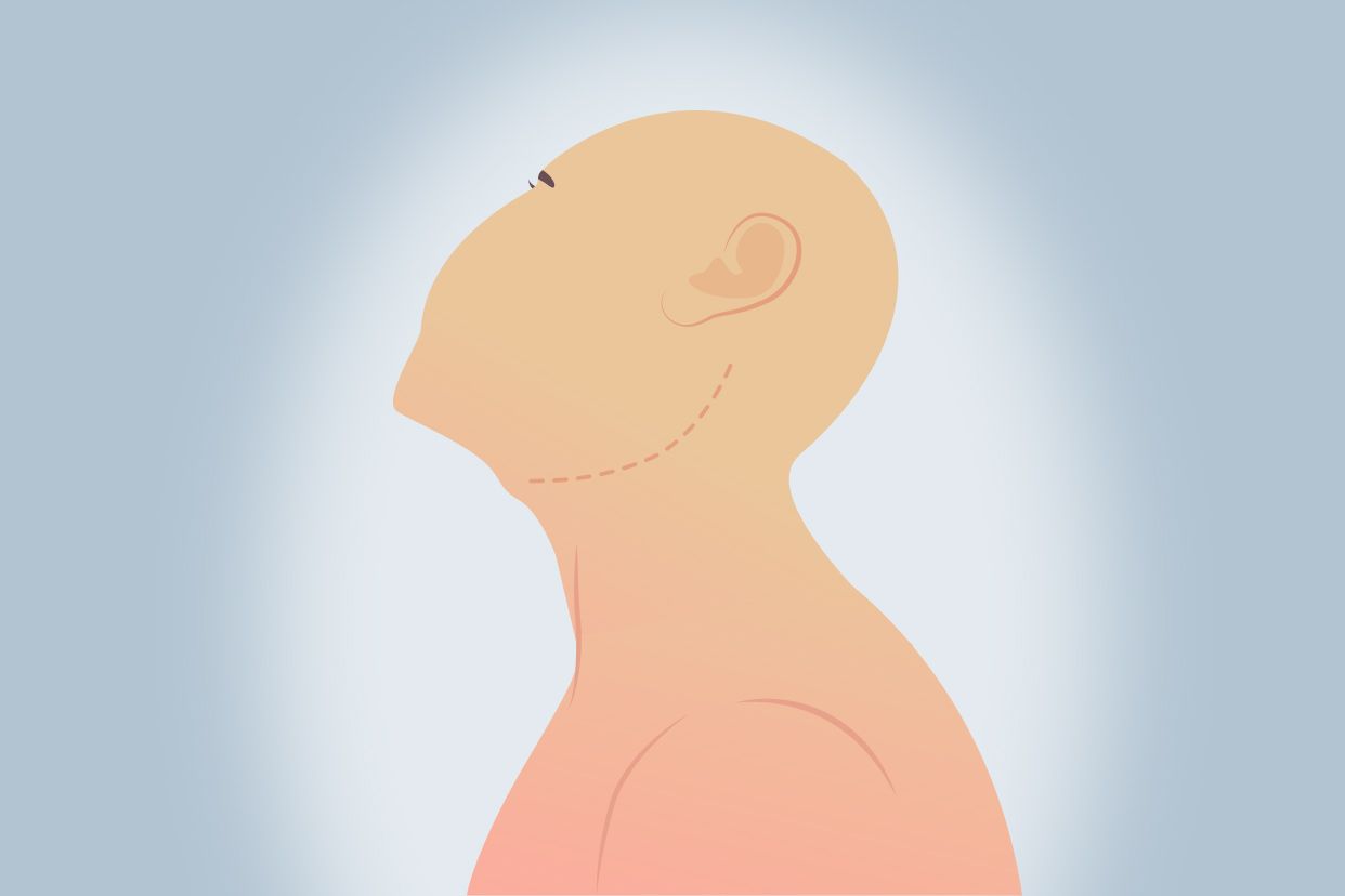 颈部手术切口图片 颈部手术切口方向图