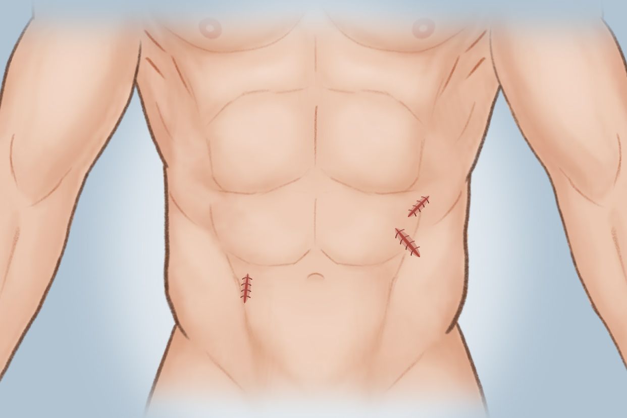 腹部手术补片是什么 腹部补片手术后图片