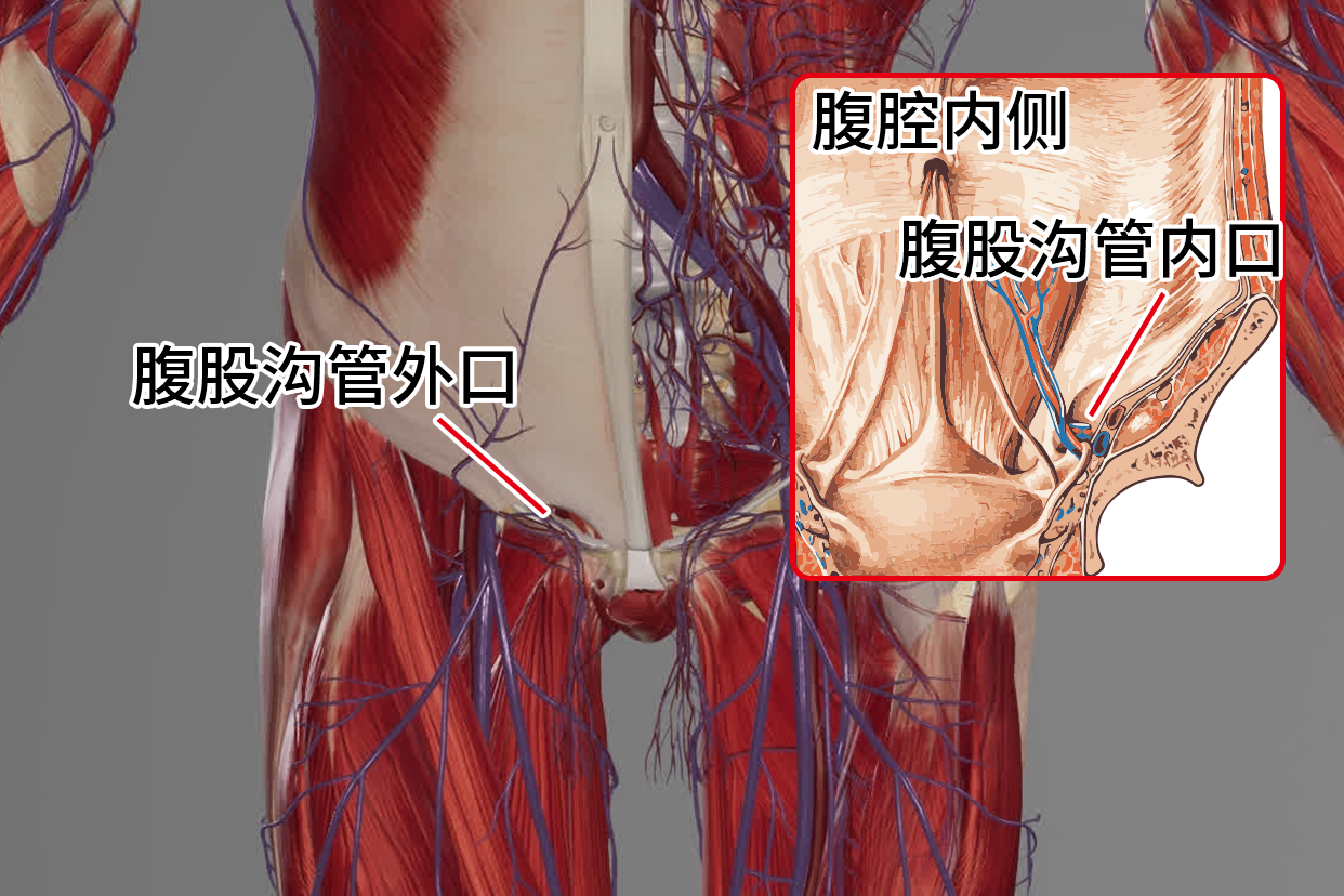 腹股沟内环口与外环口 腹股沟内外环口示意图