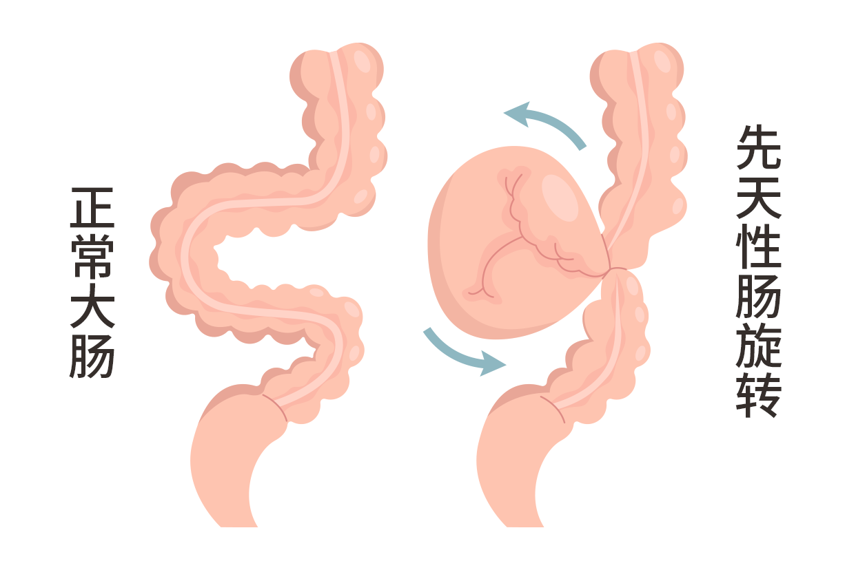 先天性肠旋转不良病理改变 先天性肠旋转不良图片