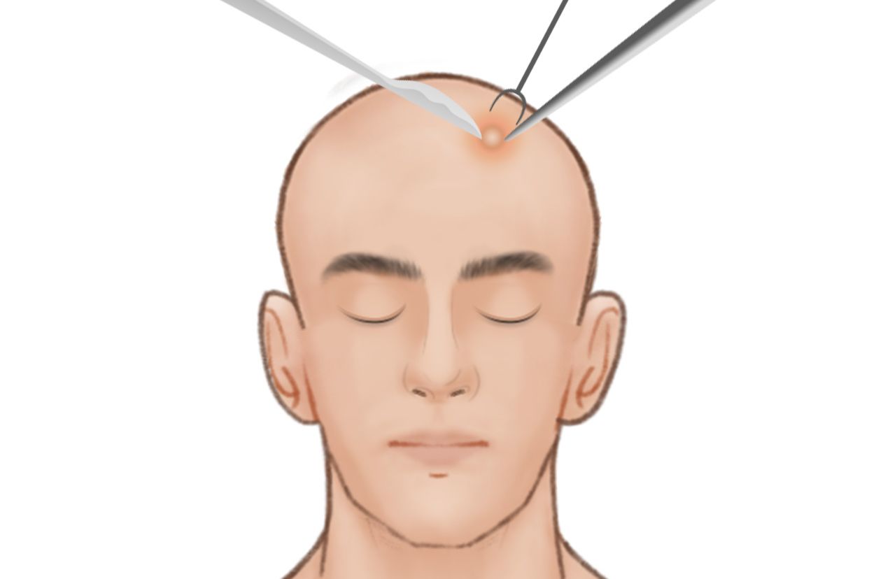 头上囊肿手术是怎么把囊肿取出来的图片