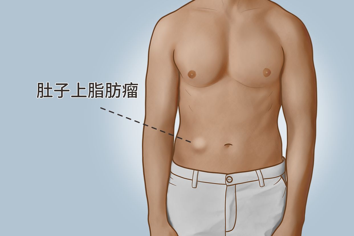 腹部多发脂肪瘤图片（腹部多发性脂肪瘤图片）