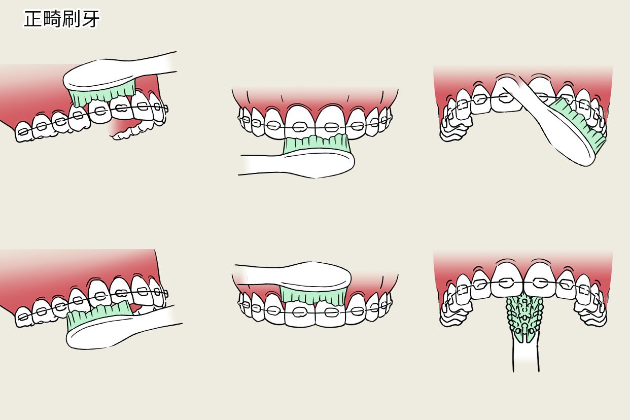 正畸刷牙步骤图片 正畸的刷牙方法