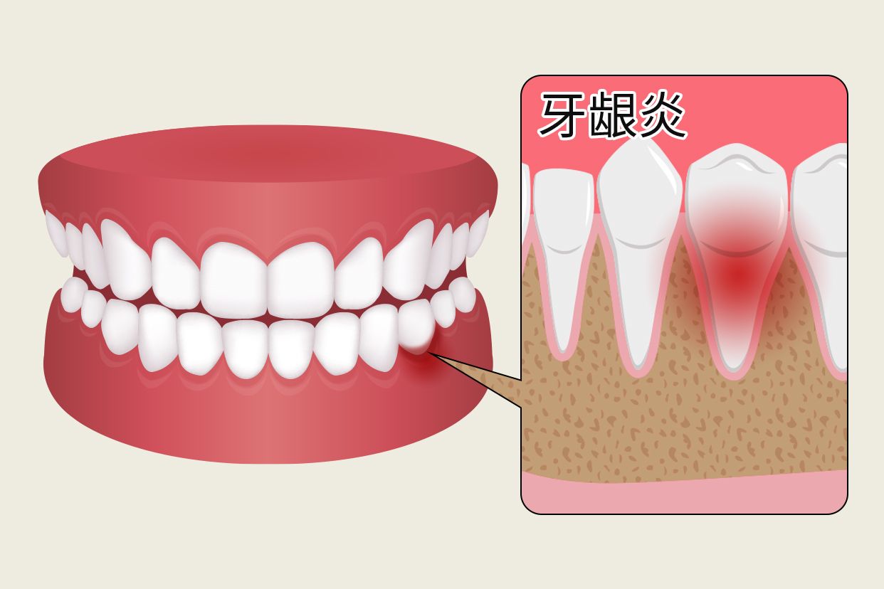 牙龈炎早期症状图片 牙龈炎初期照片