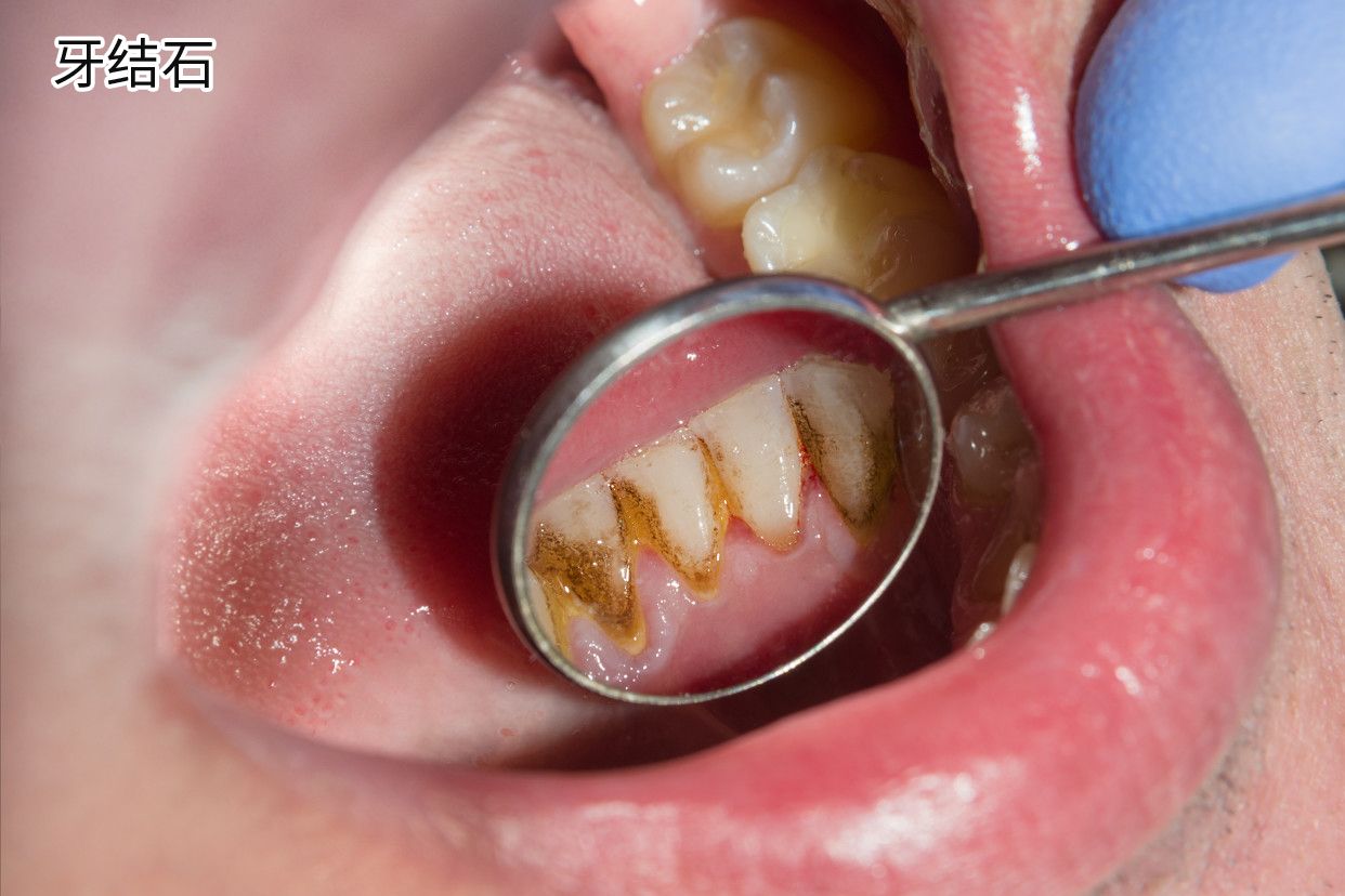 牙齿内侧牙结石图片 牙内侧的牙结石图片