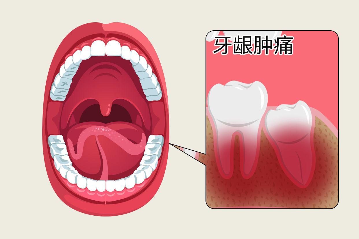牙龈肿痛图片内侧 最里面的牙龈肿痛图片