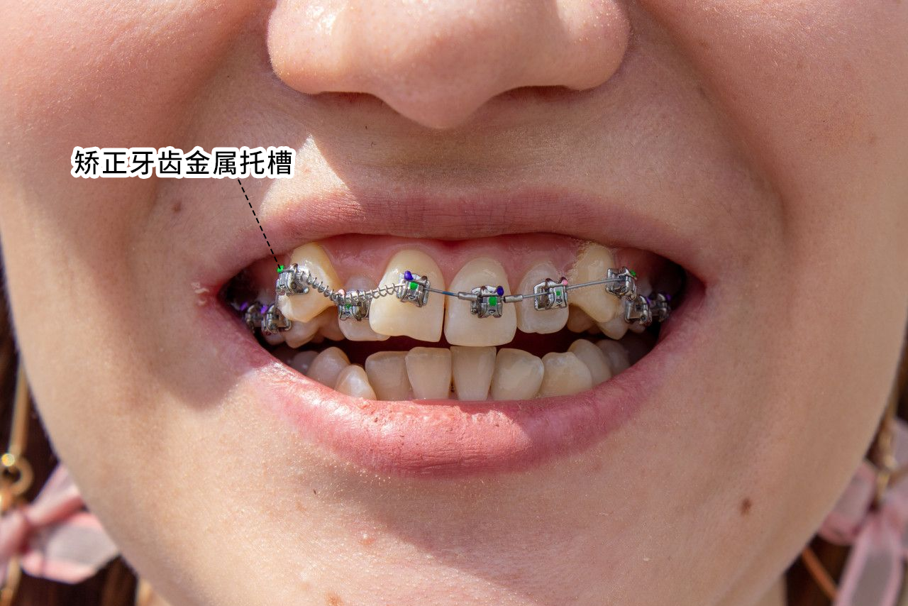 矫正牙齿金属托槽图片（牙齿矫正 托槽）