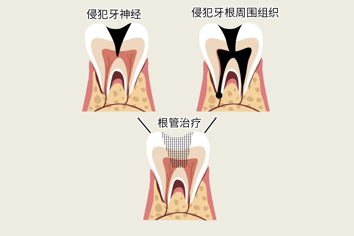 牙烂到什么程度还能治 牙烂到什么程度要根管治疗图片