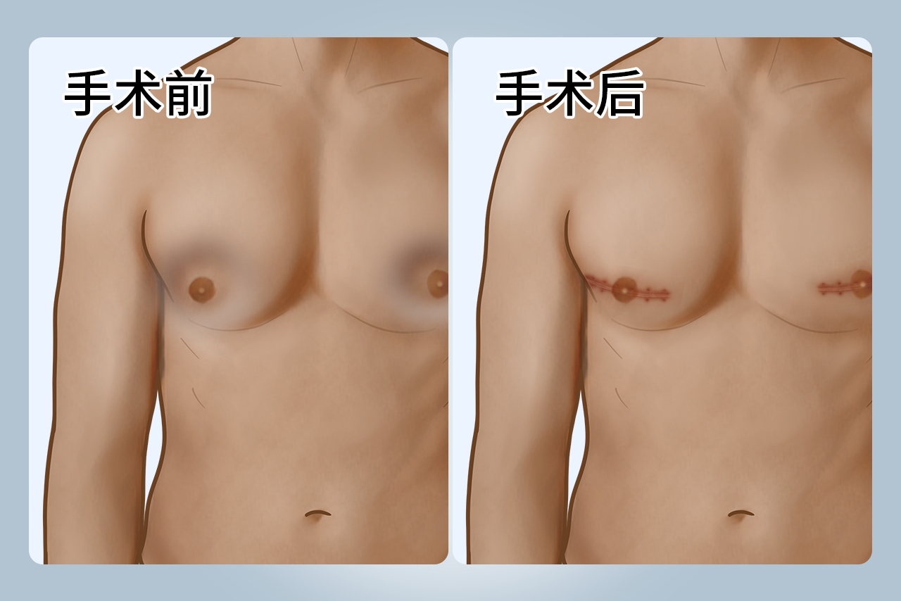 男性乳房手术后凹陷填充图片（男性乳房手术后凹陷填充图片视频）