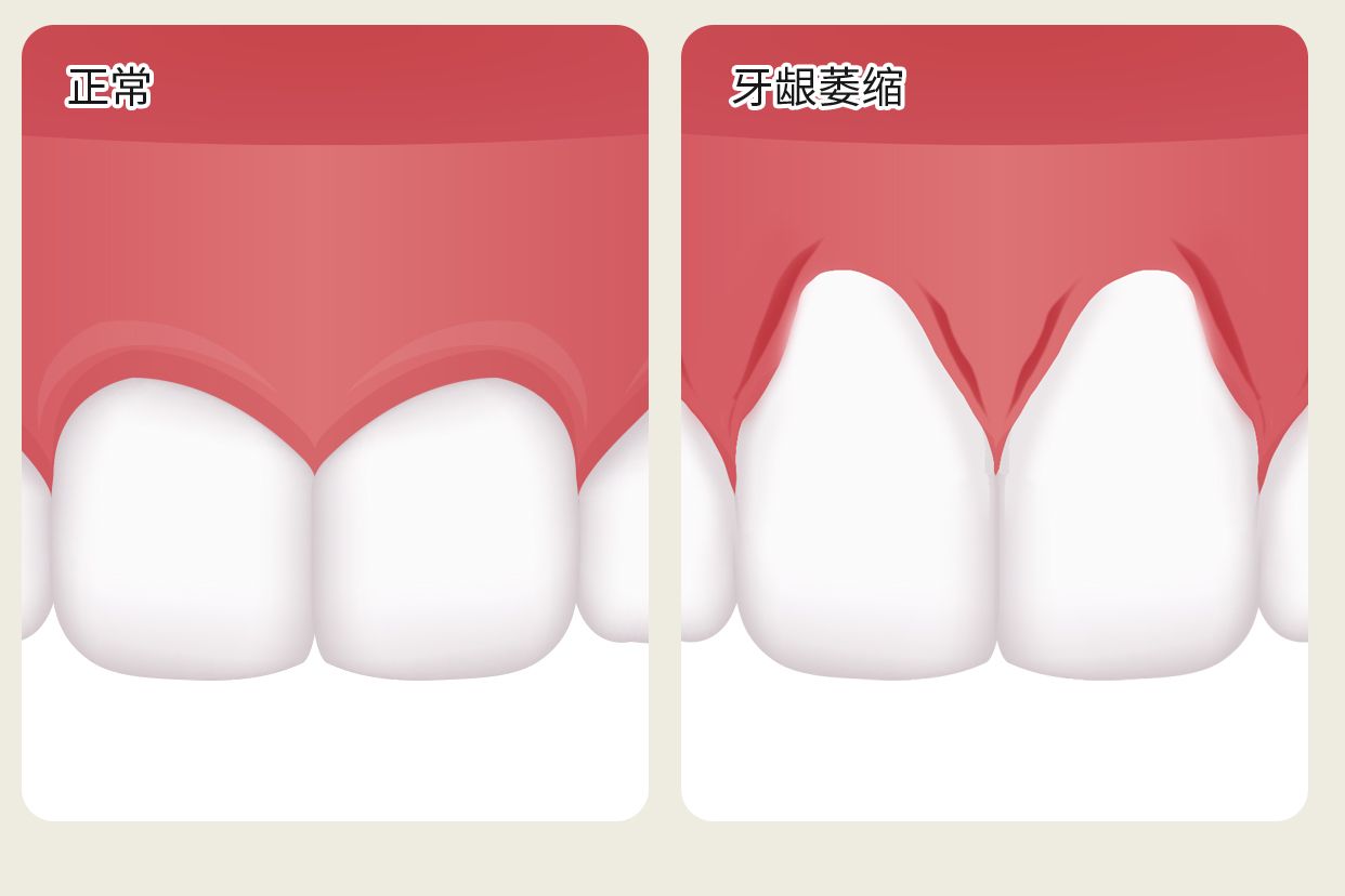 正常没萎缩的牙龈图片 正常没萎缩的牙龈图片大全