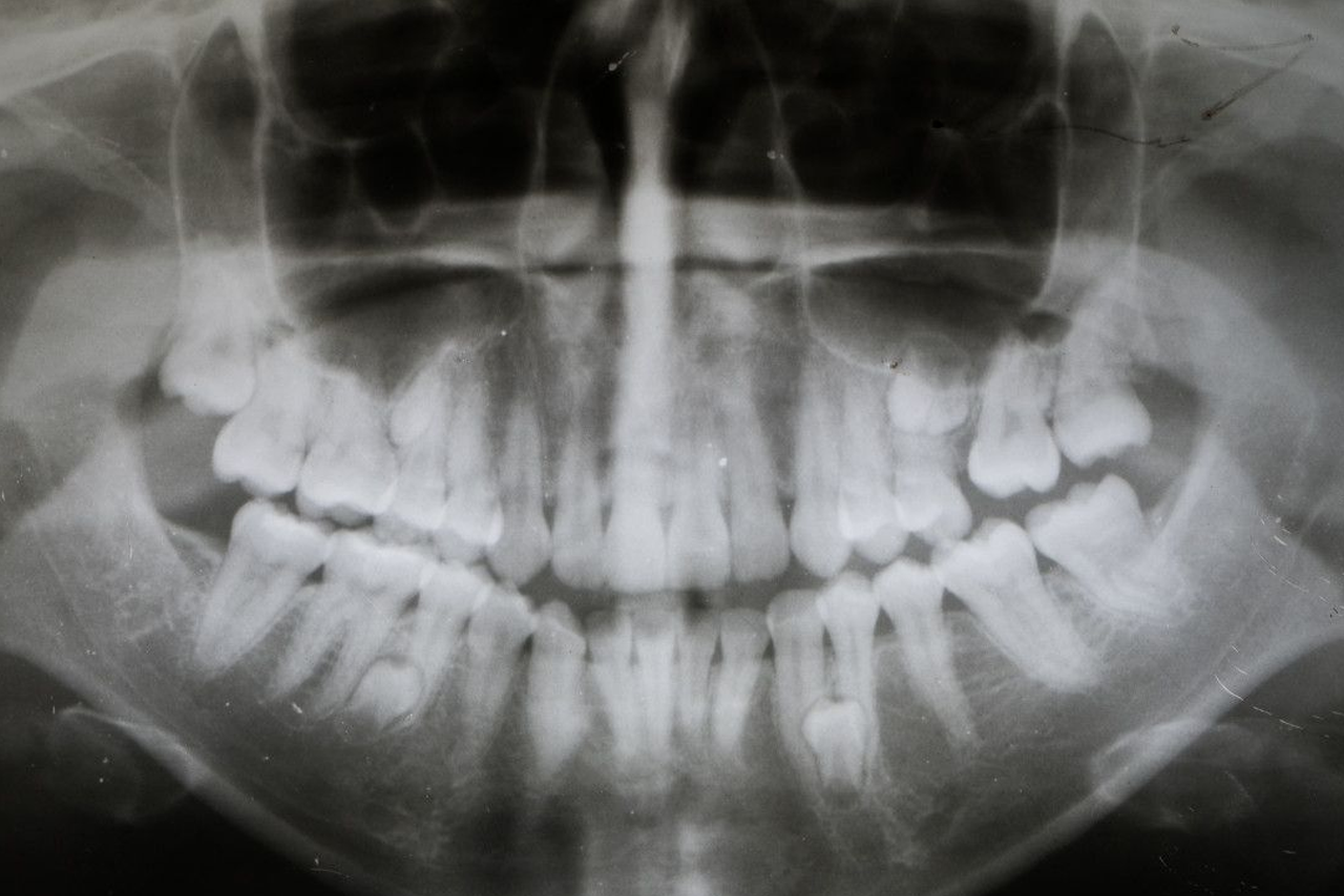 牙齿拥挤x光图 牙齿X光图