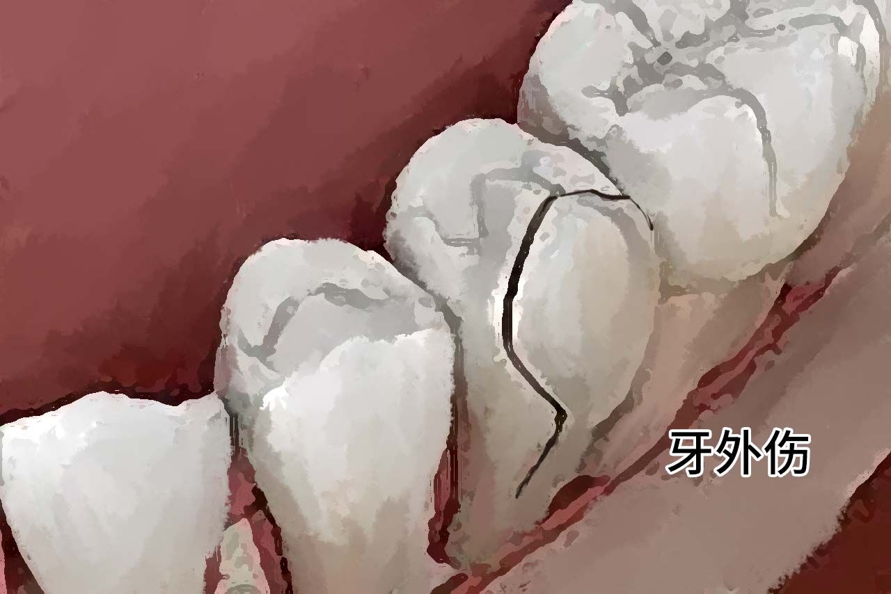 牙外伤图片（牙外伤图片 视频）