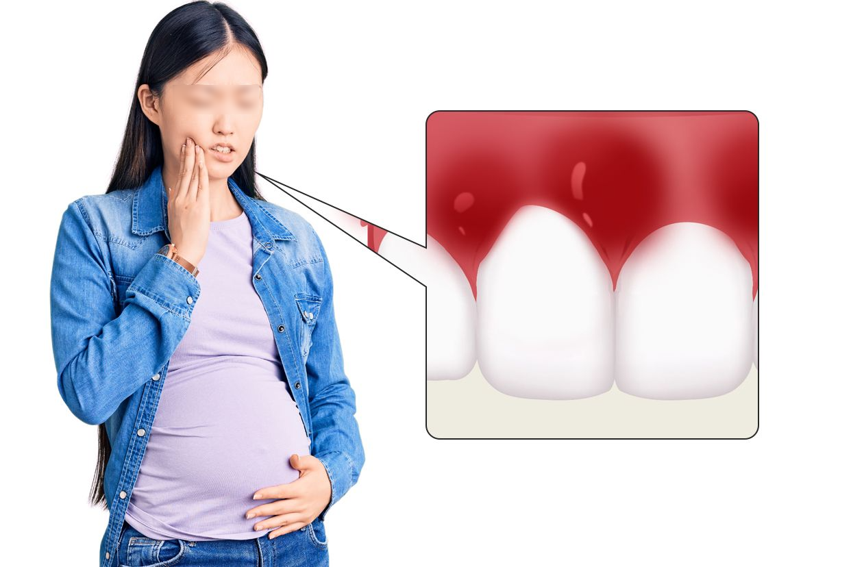 妊娠期牙龈炎图片和症状 妊娠期牙龈炎图片