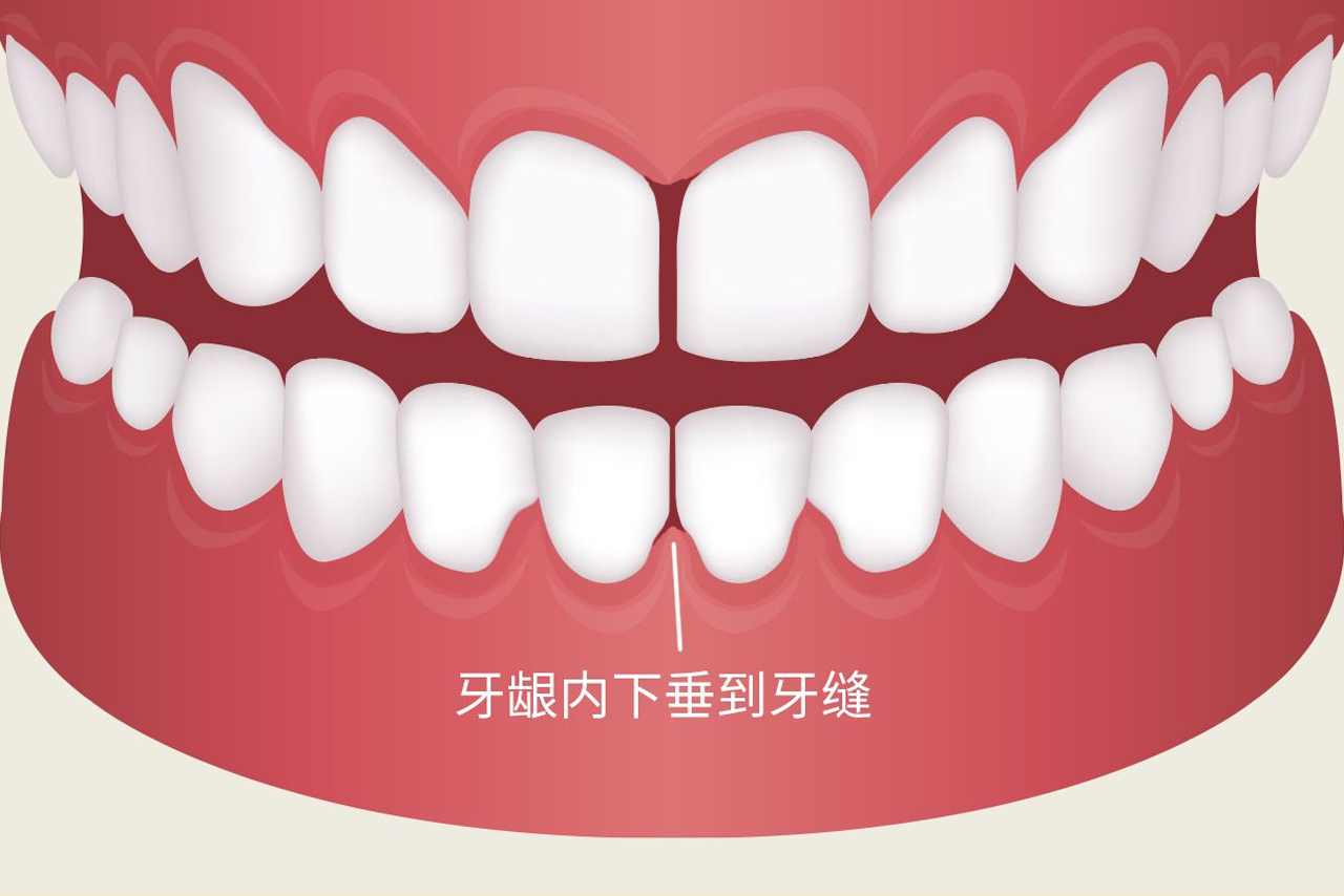 牙龈内下垂到牙缝是什么引起的图片 牙龈垂下来是怎么回事