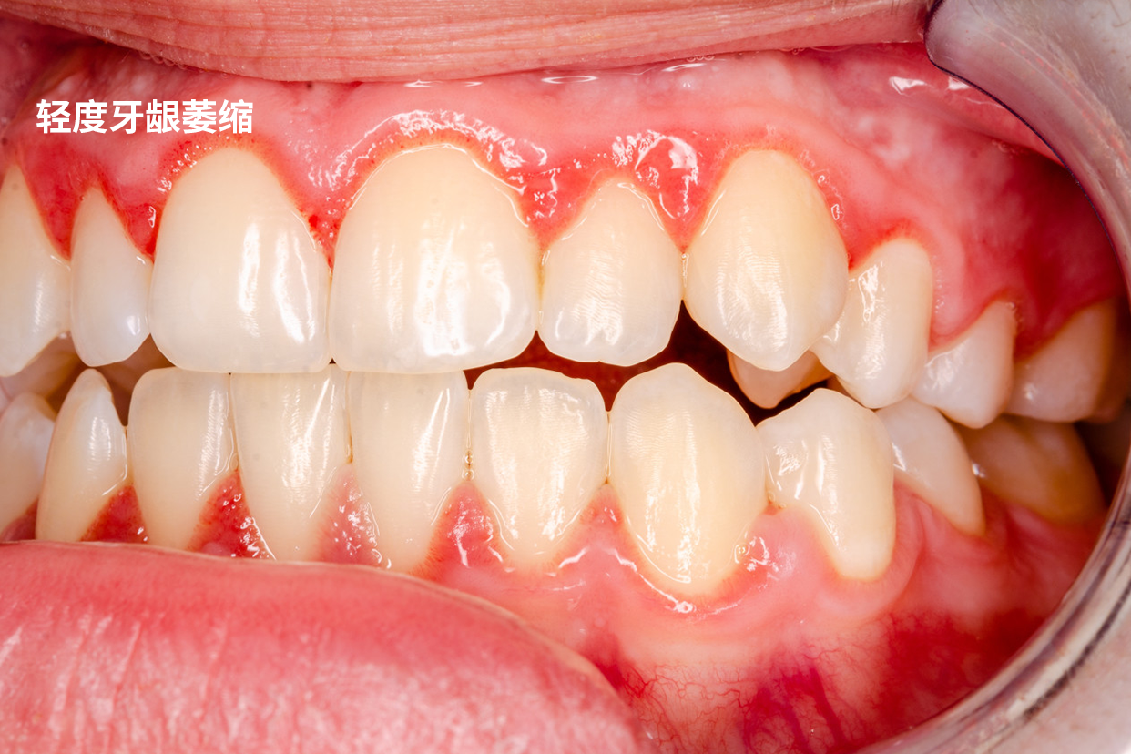 轻度牙龈萎缩图片初期 牙龈萎缩各个阶段图片