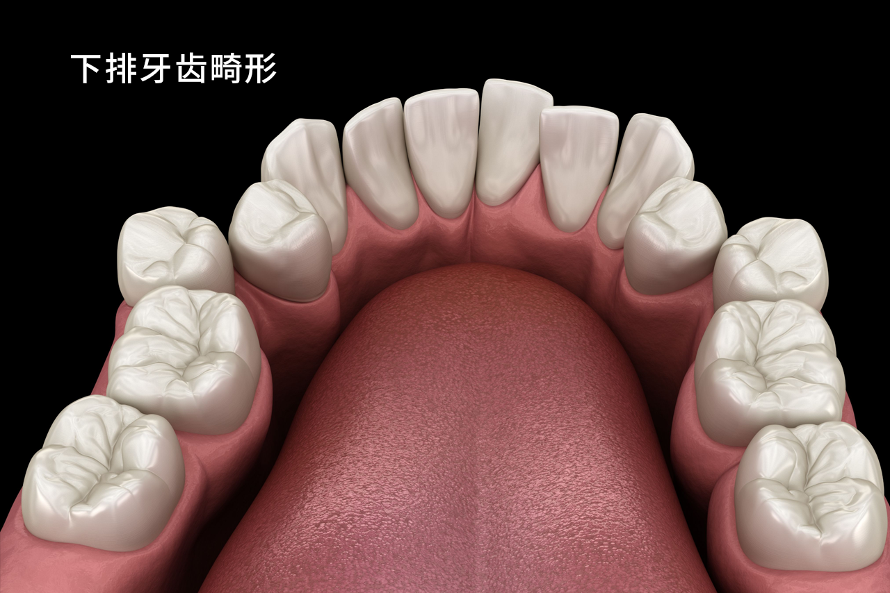 下排牙齿畸形图 下排牙齿畸形图解