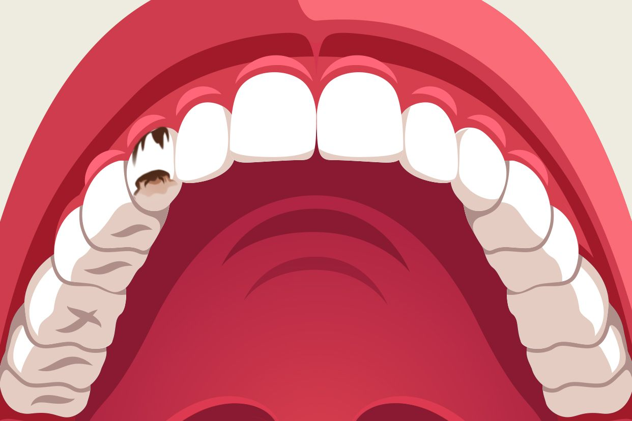 尖牙蛀牙图片（尖牙蛀牙图片）