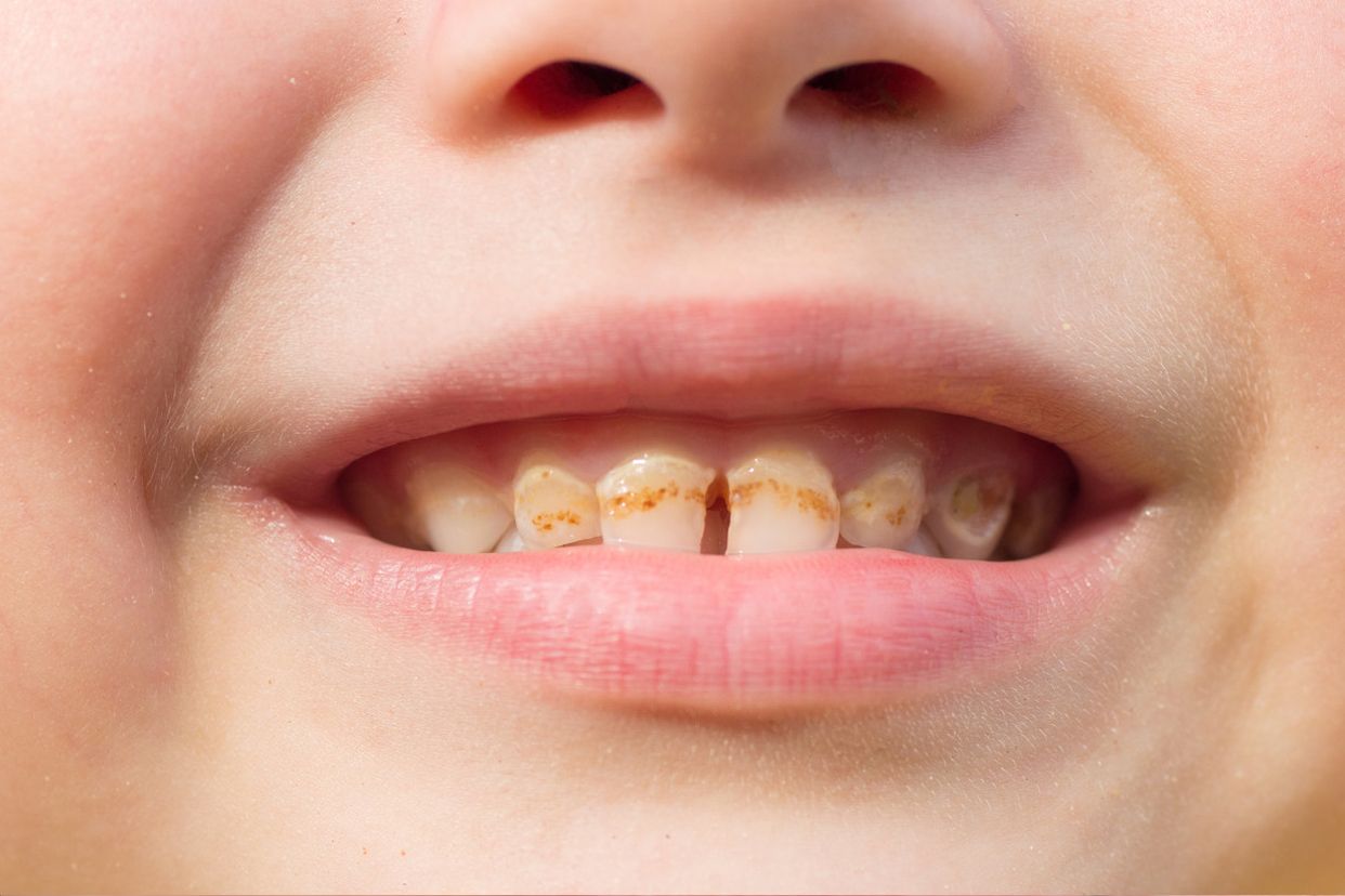 门牙龋齿严重程度分型图片（门牙龋齿严重程度分型图片解析）