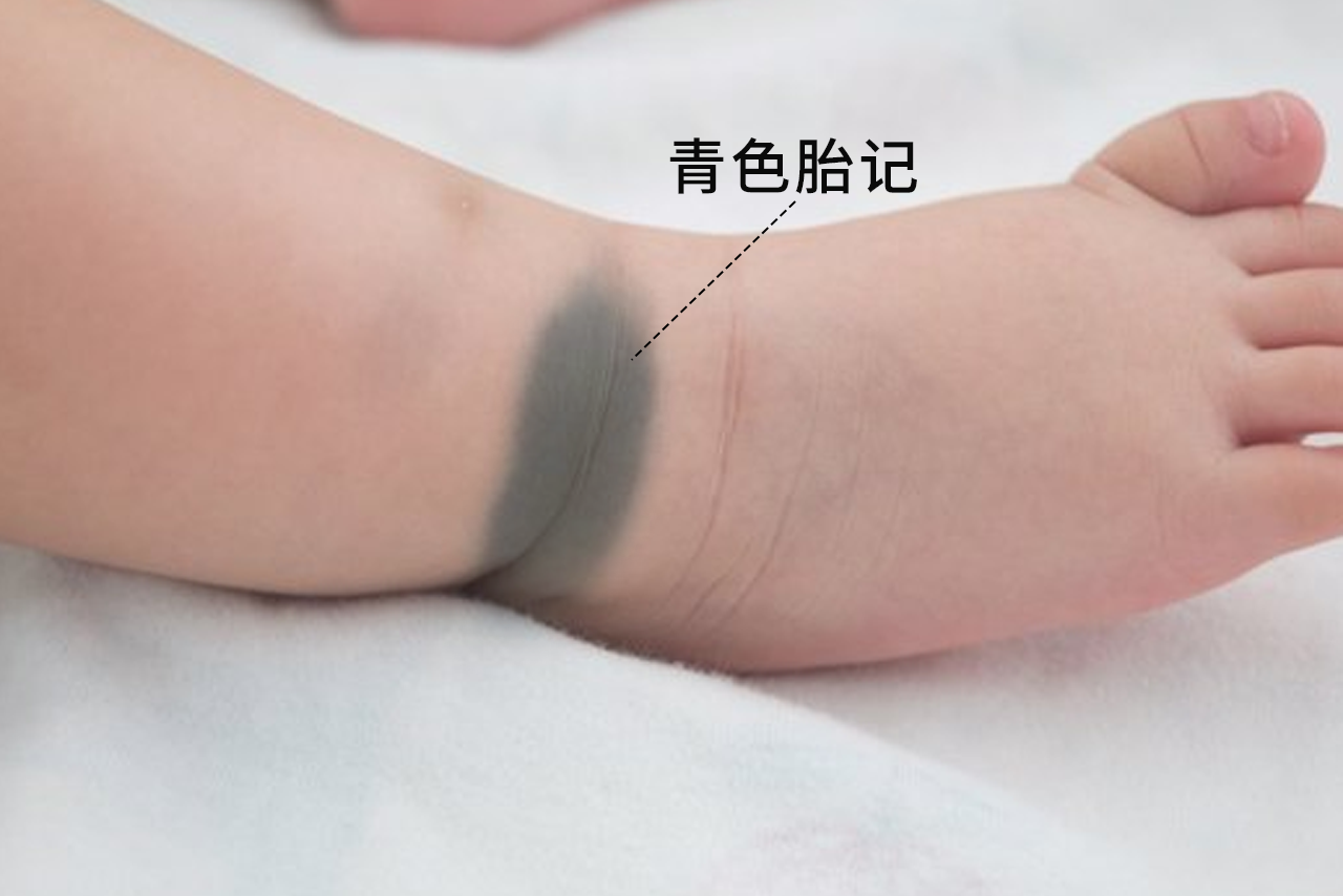 婴儿青色胎记图片 蒙古斑和青色胎记区别的图片