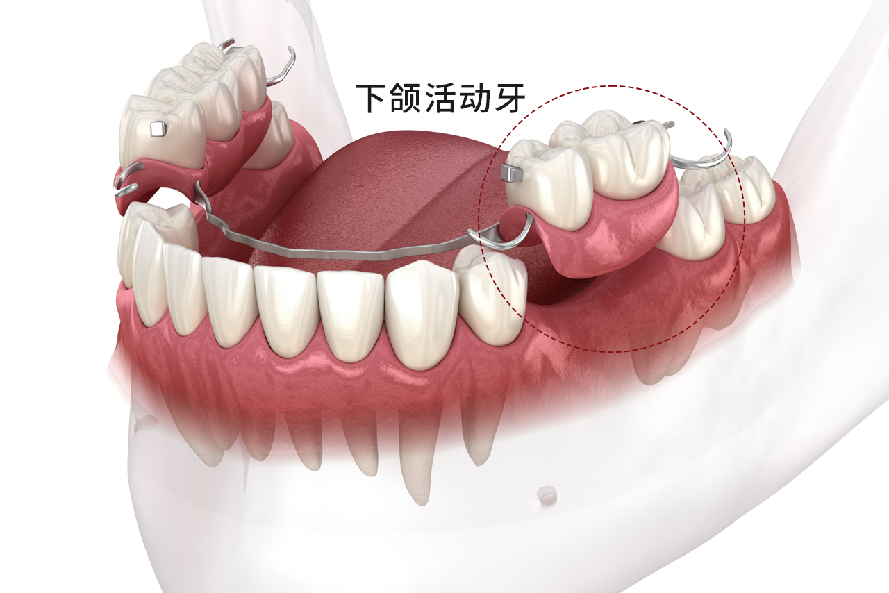 下颌活动牙图片 下颌活动义齿图片