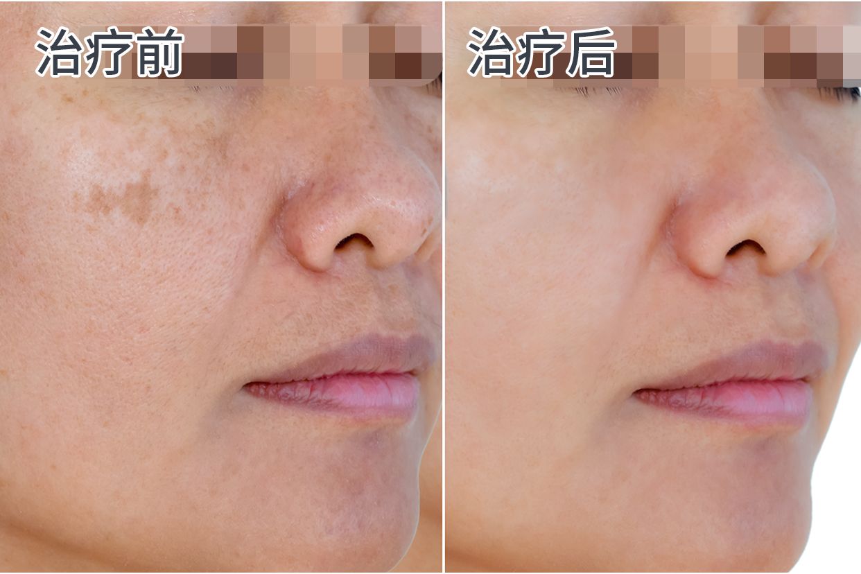 二氧化碳激光治疗老年斑后的图片（二氧化碳激光袪斑）