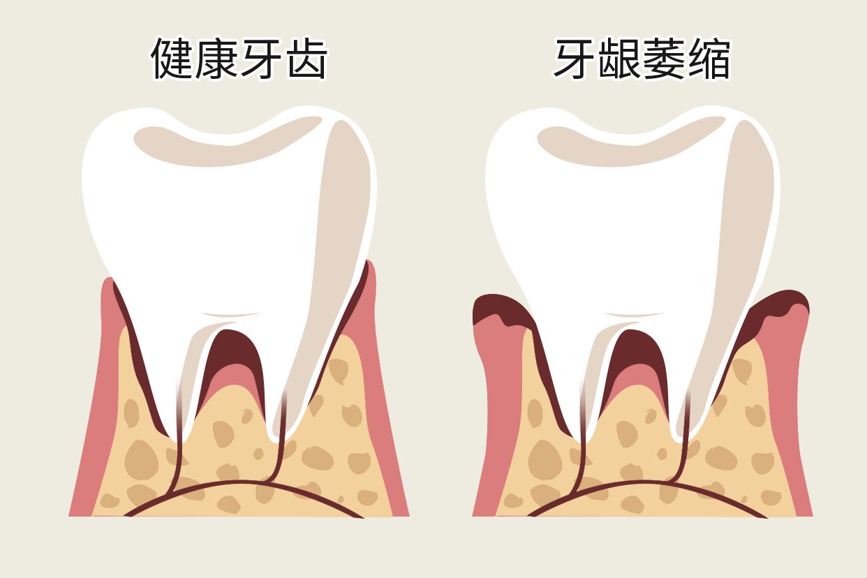 单个牙龈萎缩图片 正常牙龈和萎缩牙龈图片