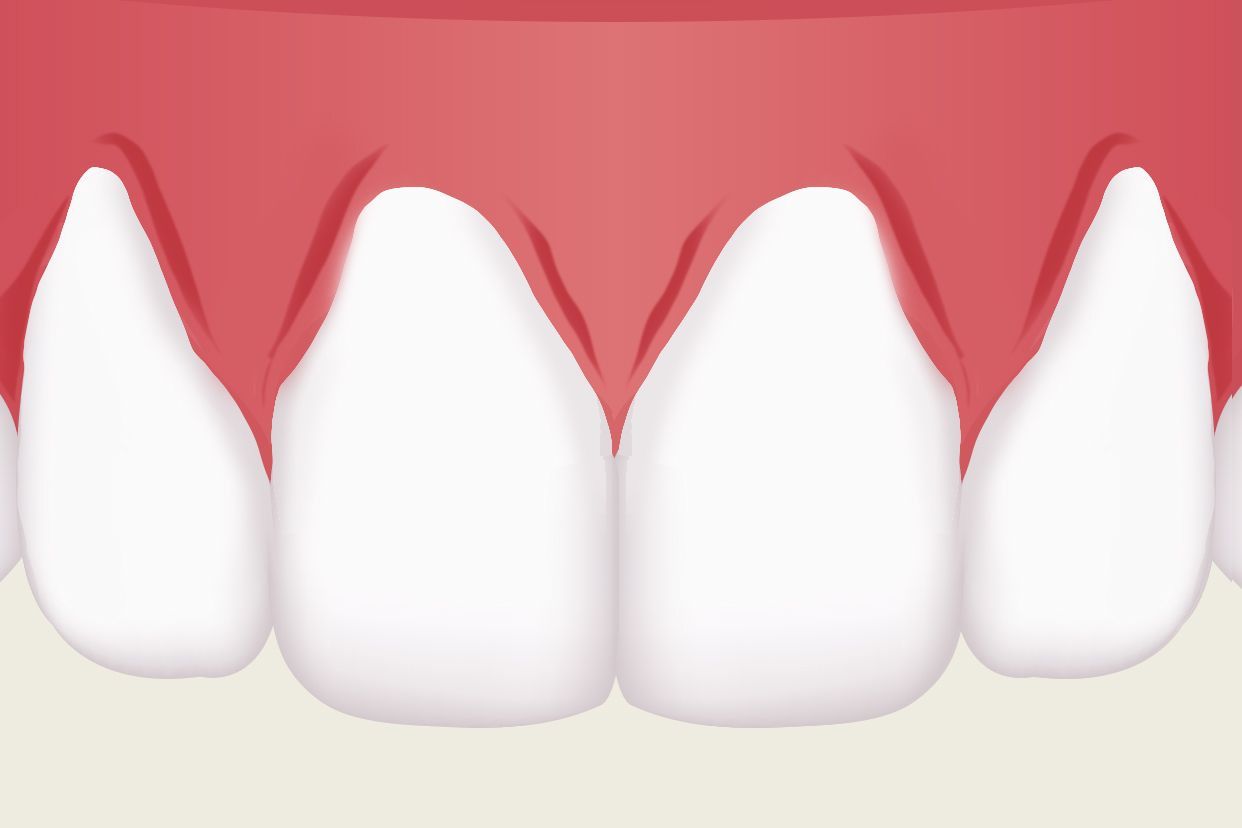 做一个牙龈修复效果图（牙龈怎么样养回来）