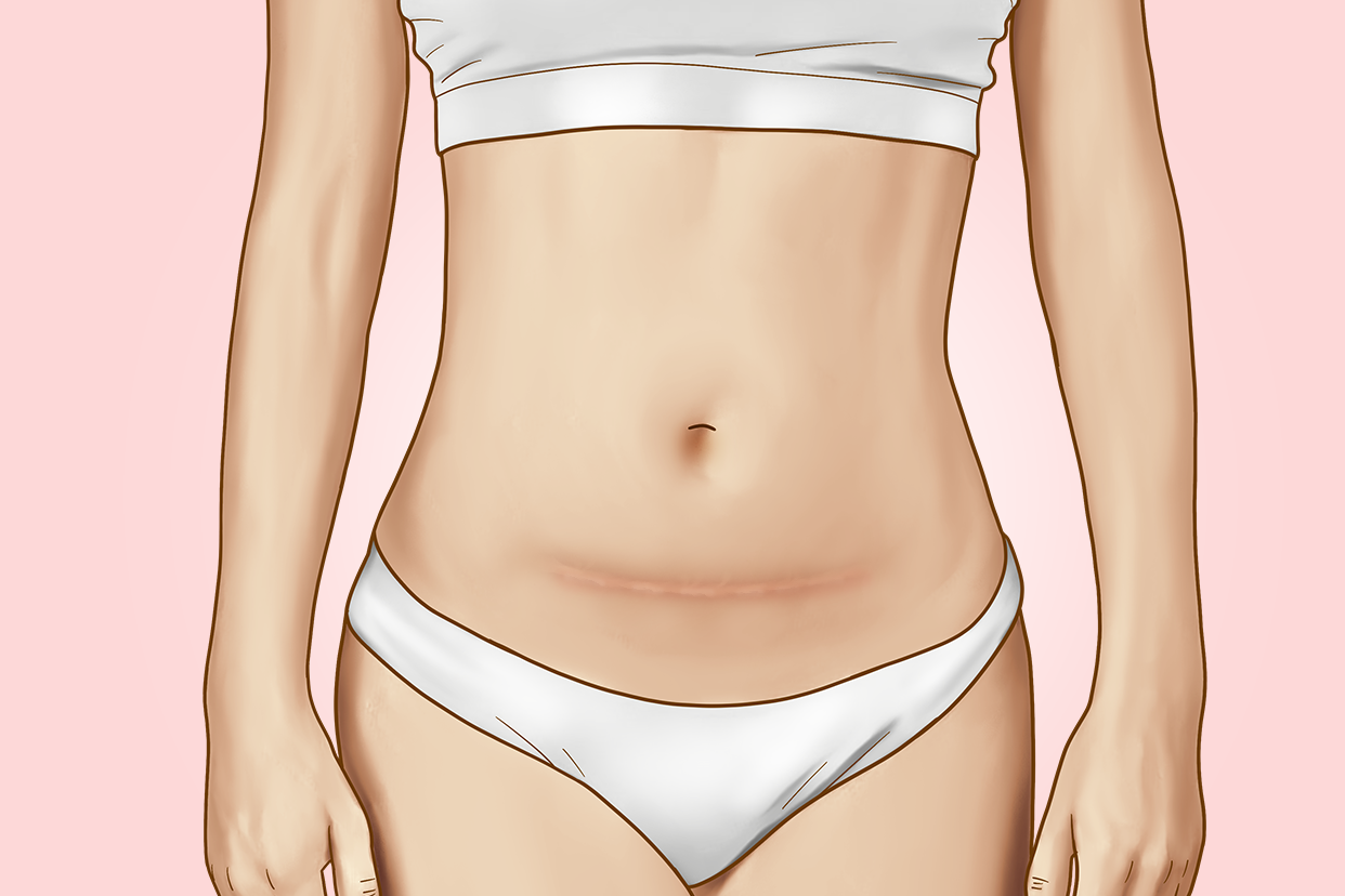 女生肚子上有刀疤是怎么回事图片 女生肚子上有刀疤是怎么回事图片
