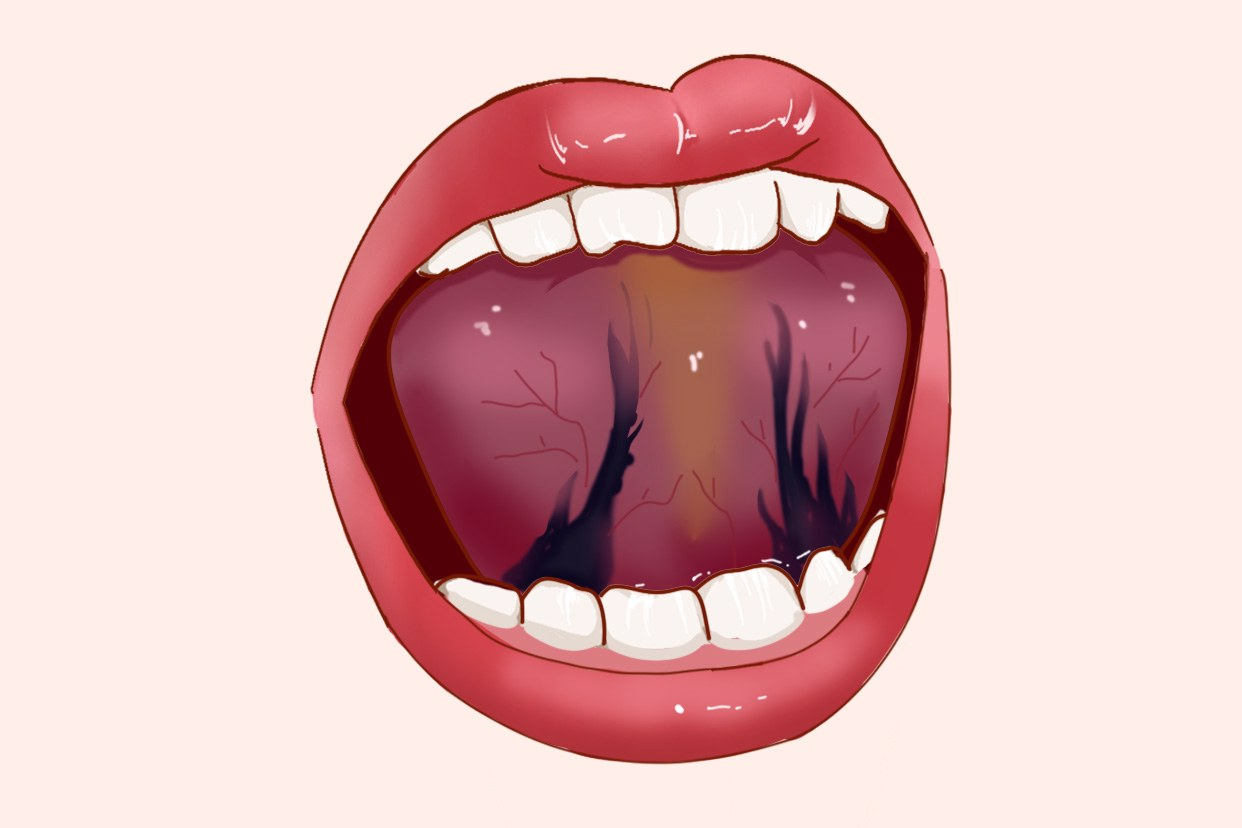 舌根淤堵图片 肝郁气滞血瘀的舌头图
