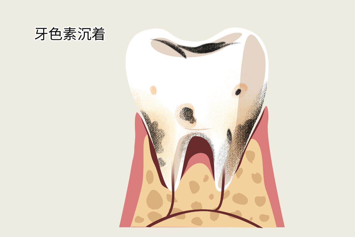 牙色素沉着和龋齿区别有图吗（浅龋中龋深龋的鉴别图片）
