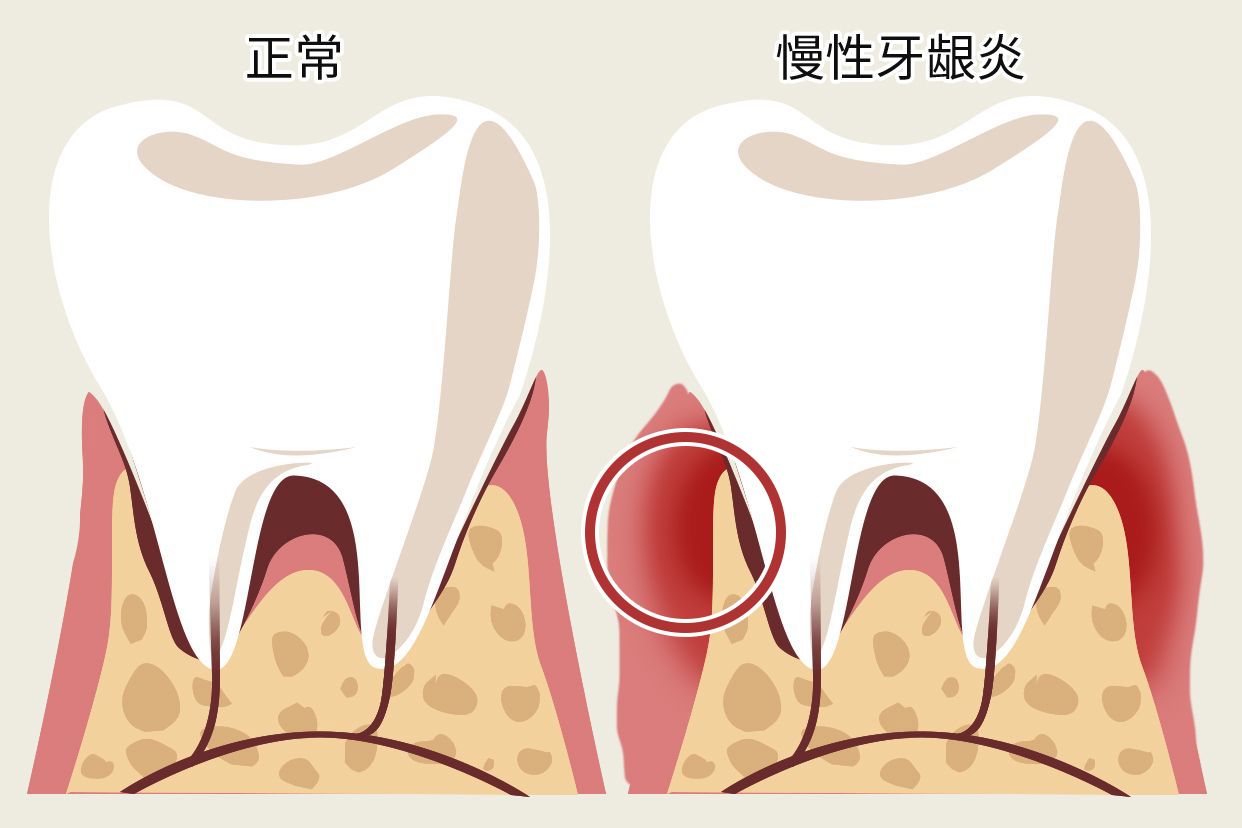 慢性牙龈炎图片 轻度牙龈炎症状图片