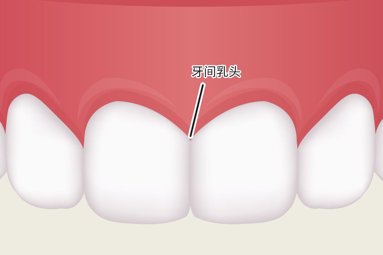 牙龈乳头图片 牙龈人乳头瘤图片