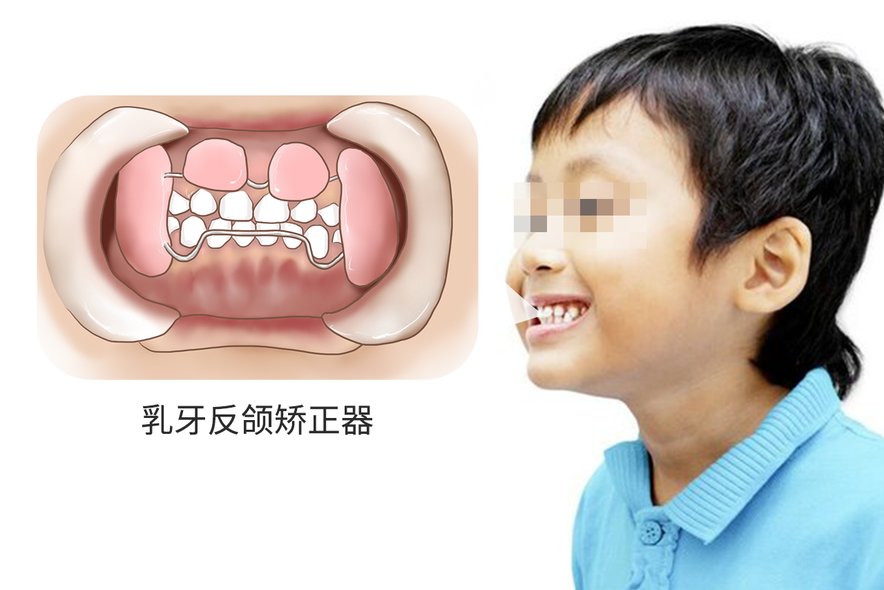 乳牙反颌矫正器图片