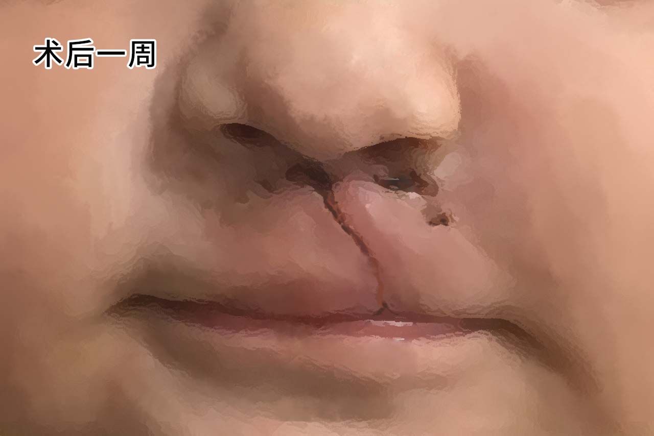 唇裂二次修复手术图片