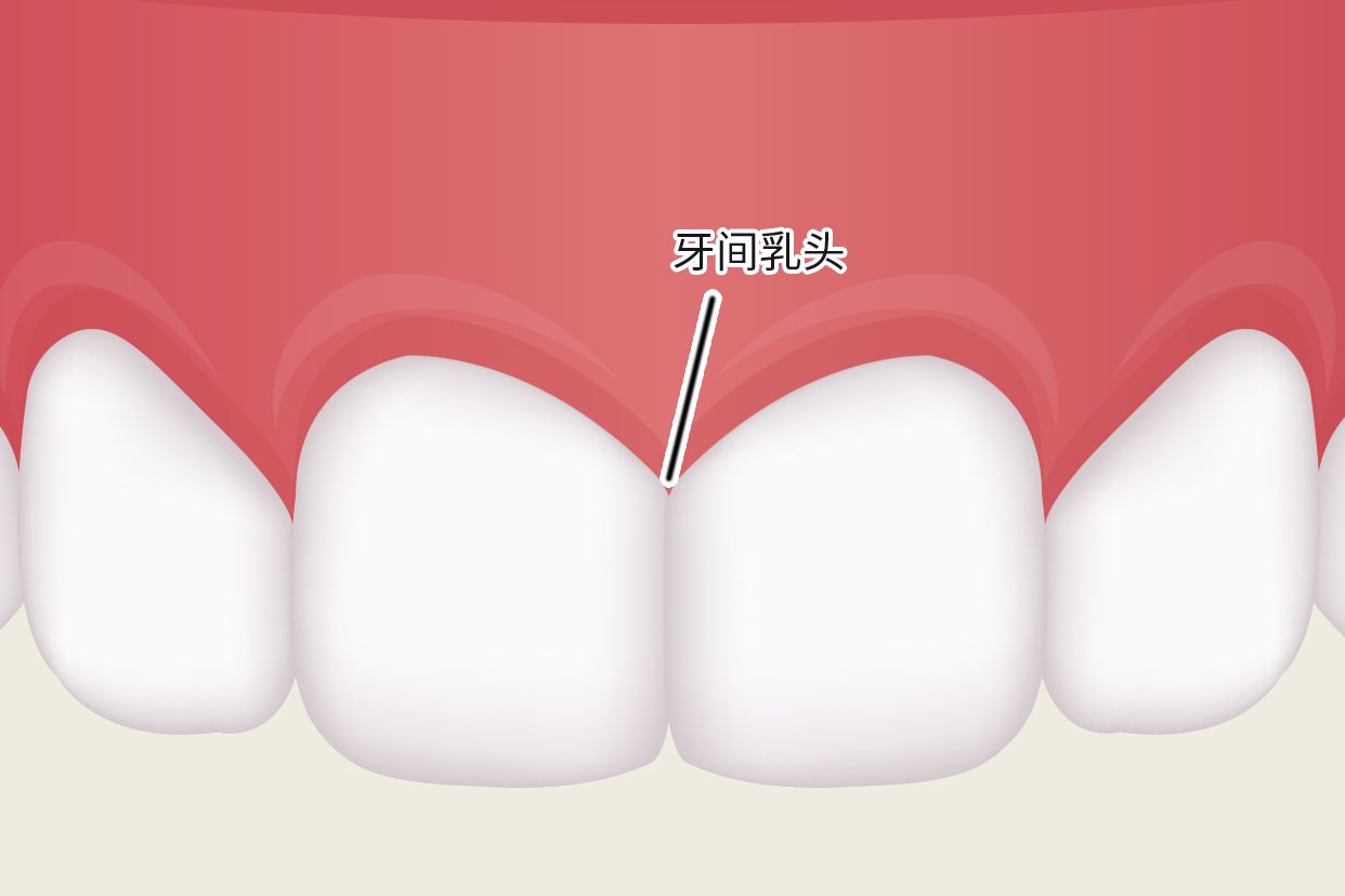 牙龈乳头图片