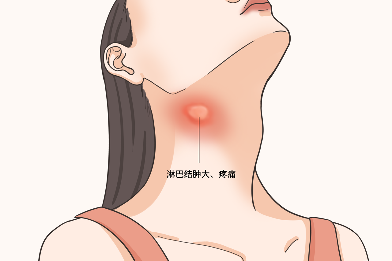 女性右侧颈部淋巴结肿大图片