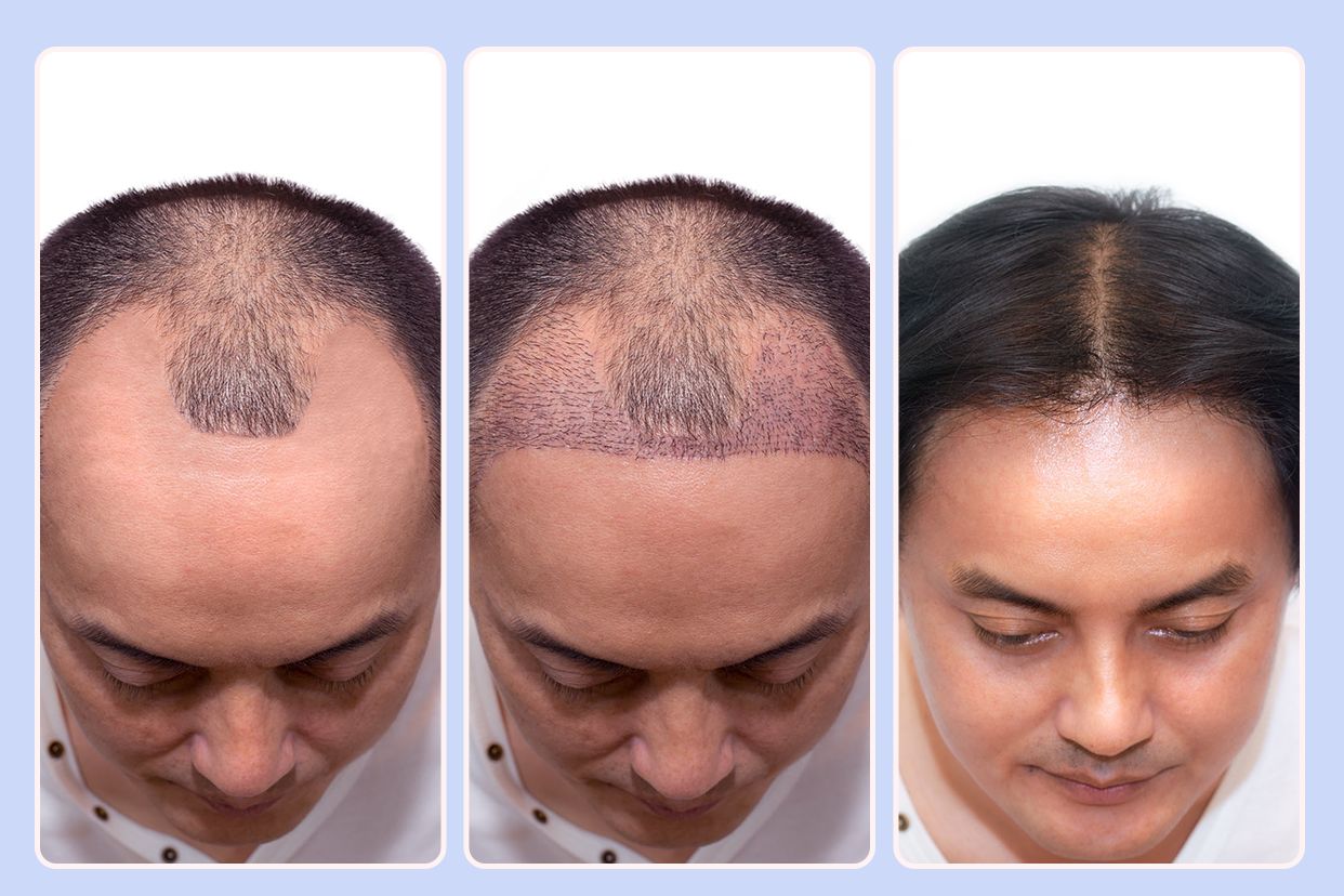 植发后头发生长过程图片
