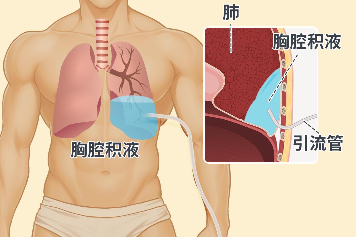 胸膜炎伤口引流管的位置图片（胸膜炎积水引流完还会有吗）